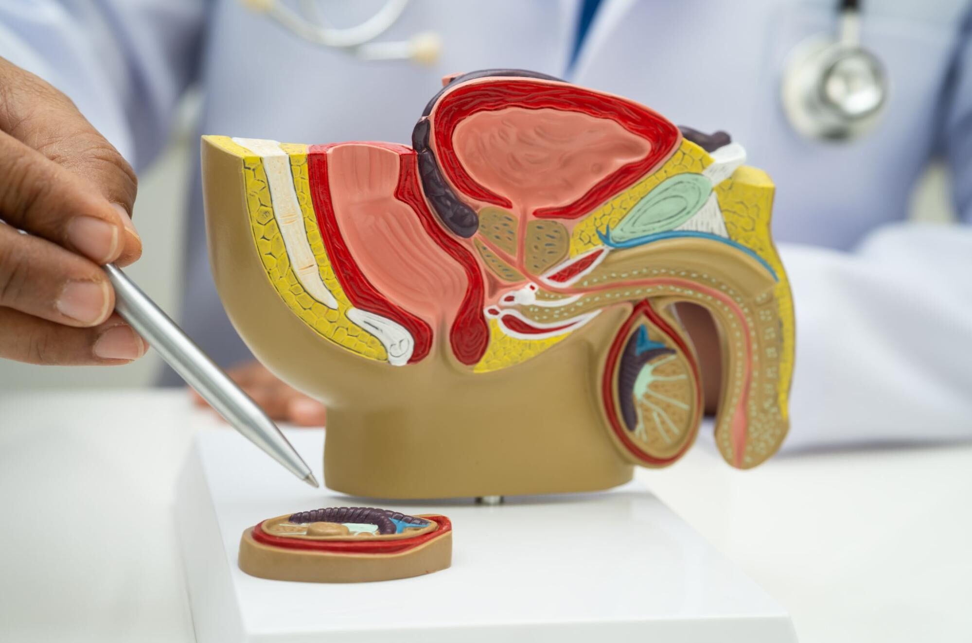 grados varicocele