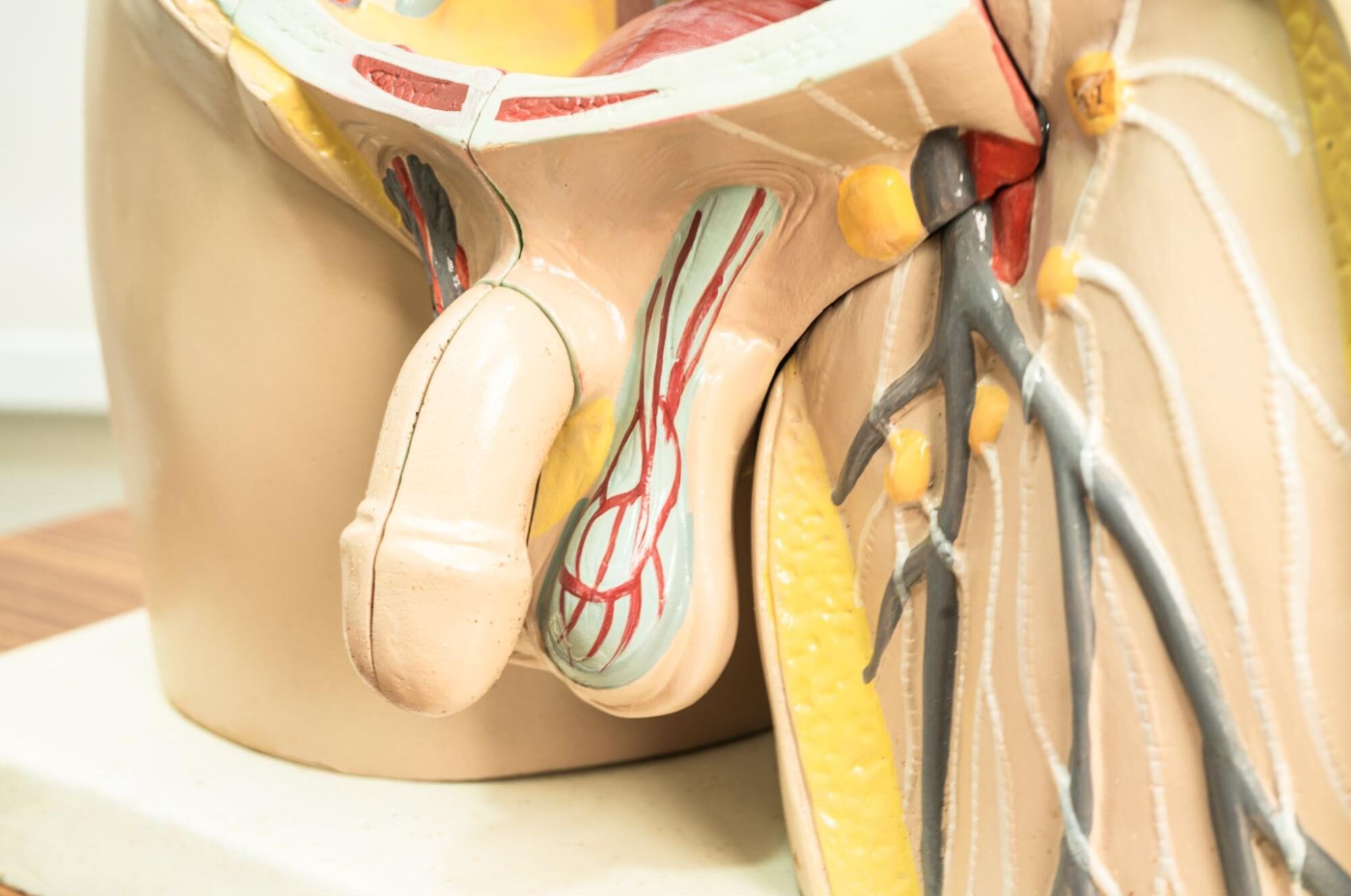 varicocele sintomas